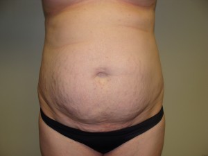 Tummy Tuck Before and After | Grover Aesthetics