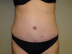Tummy Tuck Before and After | Grover Aesthetics