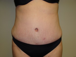 Tummy Tuck Before and After | Sanjay Grover MD FACS