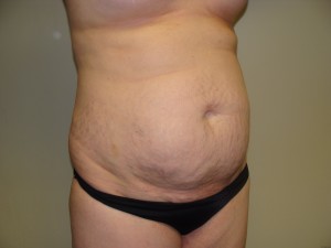 Tummy Tuck Before and After 58 | Sanjay Grover MD FACS