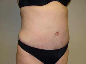 Tummy Tuck Before and After 58 | Sanjay Grover MD FACS