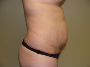 Tummy Tuck Before and After 58 | Sanjay Grover MD FACS