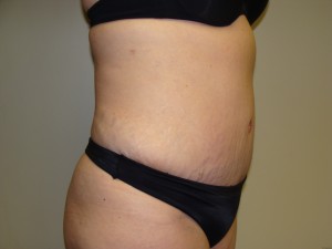 Tummy Tuck Before and After 58 | Sanjay Grover MD FACS