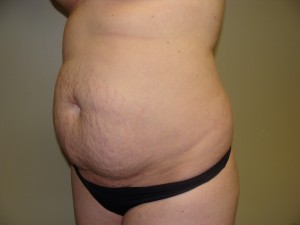 Tummy Tuck Before and After 58 | Sanjay Grover MD FACS