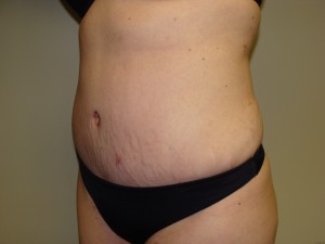 Tummy Tuck Before and After 58 | Sanjay Grover MD FACS