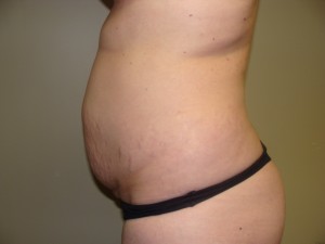 Tummy Tuck Before and After 58 | Grover Aesthetics