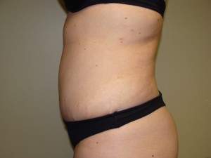 Tummy Tuck Before and After 58 | Sanjay Grover MD FACS