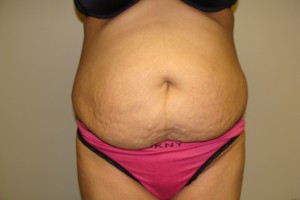 Tummy Tuck Before and After 48 | Sanjay Grover MD FACS