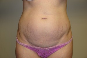 Tummy Tuck Before and After 09 | Sanjay Grover MD FACS