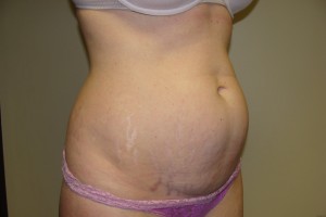 Tummy Tuck Before and After 59 | Grover Aesthetics