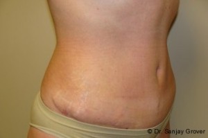 Tummy Tuck Before and After 59 | Sanjay Grover MD FACS