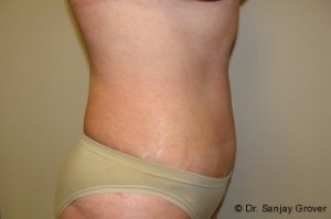 Tummy Tuck Before and After 59 | Sanjay Grover MD FACS