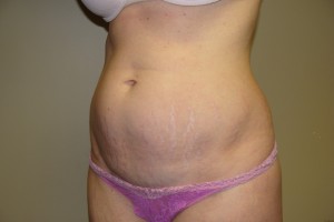 Tummy Tuck Before and After 59 | Sanjay Grover MD FACS