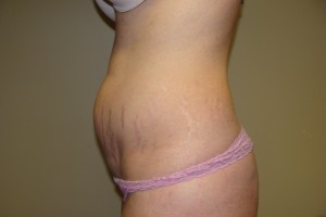 Tummy Tuck Before and After 59 | Grover Aesthetics