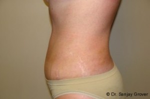 Tummy Tuck Before and After 59 | Grover Aesthetics