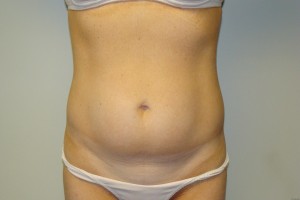 Tummy Tuck Before and After | Grover Aesthetics