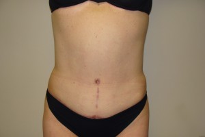 Tummy Tuck Before and After | Grover Aesthetics