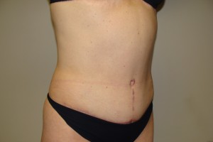 Tummy Tuck Before and After 60 | Grover Aesthetics