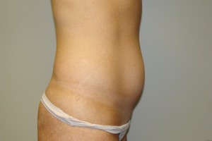 Tummy Tuck Before and After 60 | Grover Aesthetics