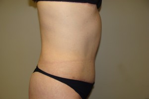 Tummy Tuck Before and After 60 | Grover Aesthetics