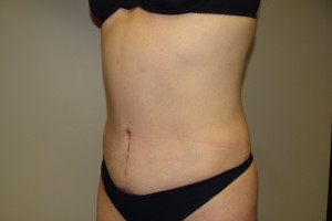 Tummy Tuck Before and After 60 | Grover Aesthetics