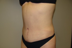 Tummy Tuck Before and After 60 | Sanjay Grover MD FACS