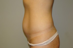 Tummy Tuck Before and After 60 | Grover Aesthetics