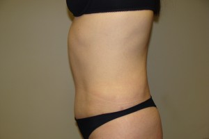 Tummy Tuck Before and After 60 | Grover Aesthetics