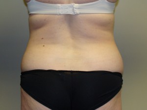 Tummy Tuck Before and After 60 | Grover Aesthetics