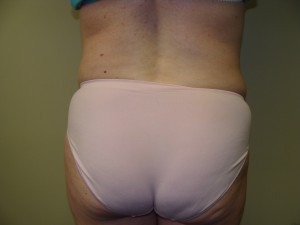 Tummy Tuck Before and After 60 | Grover Aesthetics