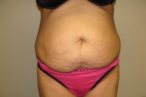 Tummy Tuck Before and After | Grover Aesthetics