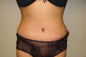 Tummy Tuck Before and After | Grover Aesthetics
