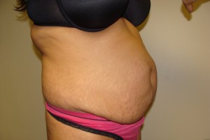 Tummy Tuck Before and After 61 | Grover Aesthetics