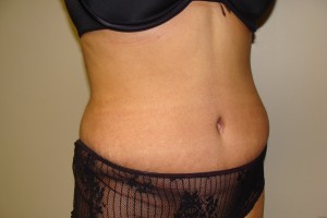 Tummy Tuck Before and After 61 | Grover Aesthetics