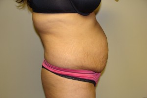 Tummy Tuck Before and After 61 | Grover Aesthetics
