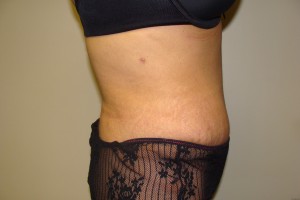 Tummy Tuck Before and After 61 | Grover Aesthetics