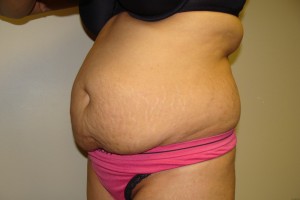 Tummy Tuck Before and After 61 | Sanjay Grover MD FACS