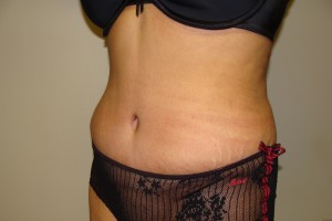 Tummy Tuck Before and After 61 | Sanjay Grover MD FACS