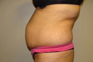 Tummy Tuck Before and After 61 | Sanjay Grover MD FACS