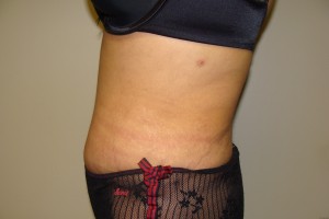 Tummy Tuck Before and After 61 | Sanjay Grover MD FACS