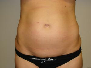 Tummy Tuck Before and After | Grover Aesthetics
