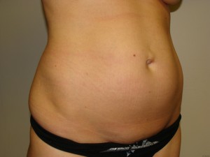 Tummy Tuck Before and After 62 | Sanjay Grover MD FACS