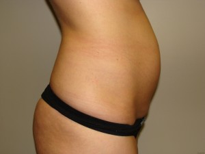 Tummy Tuck Before and After 62 | Grover Aesthetics
