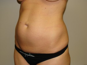 Tummy Tuck Before and After 62 | Sanjay Grover MD FACS