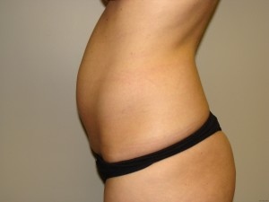 Tummy Tuck Before and After 62 | Grover Aesthetics