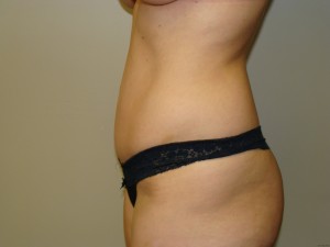Tummy Tuck Before and After 62 | Grover Aesthetics