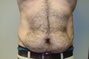 Tummy Tuck Before and After | Grover Aesthetics