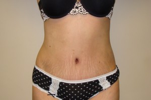 Tummy Tuck Before and After 63 | Sanjay Grover MD FACS