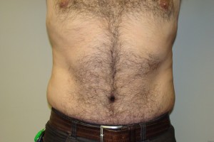 Tummy Tuck Before and After | Grover Aesthetics
