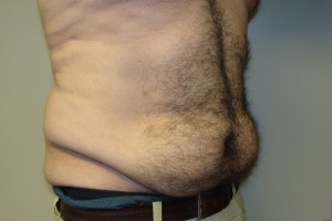 Tummy Tuck Before and After 63 | Sanjay Grover MD FACS